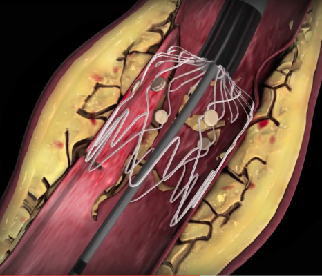 New Technologies to Treat Peripheral Artery Disease (PAD) | DAIC